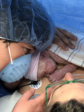 Pandemic C-Section Birth Due to Fibroid Complications